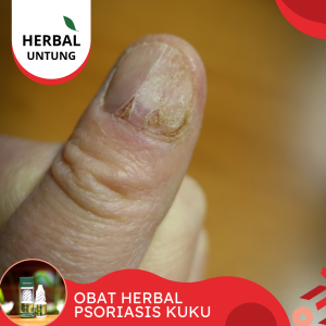 Obat Herbal Psoriasis Kuku Obat Jamur Infeksi Kuku Jamur Kuku Busuk Propolis Sm Halal Bpom