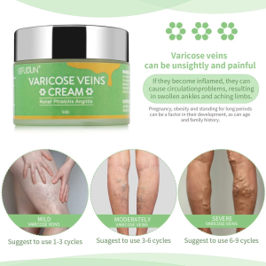 Natural Ingredients Only! 50g Sefudun Varicose Cream Soothes Legs Safely