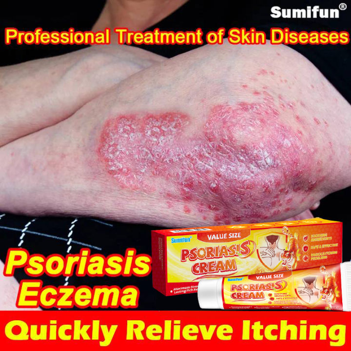 【COD】Eczema Treatment Cream SUMIFUN Solution for Psoriasis Eczema ...