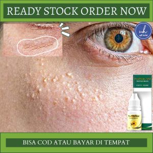 Obat Penghilang Milia Obat Oles Penghilang Milia Obat Milia Di Wajah Obat Bintik Putih Di Wajah Obat Jerawat Bayi Obat Wajah Bruntusa Obat Jerawat Putih Obat Kulit Gradakan OBat Pengempis Milia Obat Bintik Di Wajah Dengan Propolis SM