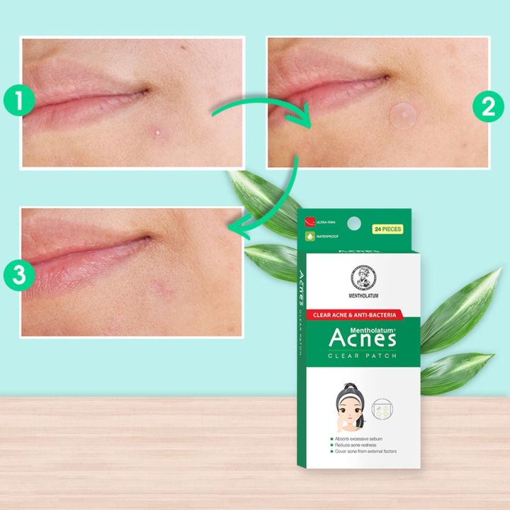 Mi%E1%BA%BFng%20D%C3%A1n%20M%E1%BB%A5n%20Acnes%20Gi%C3%BAp%20Gi%E1%BA%A3m%20M%E1%BB%A5n%2048%20Mi%E1%BA%BFng%20Clear%20Patch%20Hasaki%20s%E1%BA%A3n%20ph%E1%BA%A9m%20ch%C3%ADnh%20h%C3%A3ng%20-%20Image%204