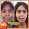 [TAHAP 1] Perapih gigi tonggos original asli Perapih gigi maju ke depan Behel gigi lepas pasang asli original Behel perapih gigi carang gingsul renggang asli dokter Alat perapih gigi monyong Alat perapih gigi maju ori Teeth Trainer Alignment Asli 100% ORI. 