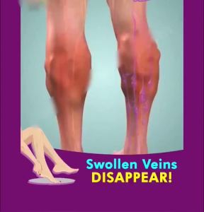 14 Days Varicose Veins Treatment Cream Varicose Veins Remover Effectively Dredge Vein Effectively Soothing Varicose Vein Soothing Leg Pain and Earthworm Leg Relief Leg Vasculitis Phlebitis Pain-152c4c8b