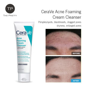 🔥Free Shipping🔥CeraVe Acne Foaming Cream Cleanser with 4%Benaoyl Peroxide Hydrating Facial Cleanser with Hyaluronic Acid & Niacinamide Cleanser for Daily Face Clean Acne Control 150ML🔥Fast delivery&Ready Stock🔥