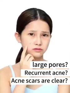 Aichun Anti Acne Removal Cream Azelaic Acid Gel Reduce Acne Scars Restore Skin Fade Acne Scars Salicylic Acid Remove Blackheads Tighten Pores Blackhead Removal Cream Control Oil Prevent Ac