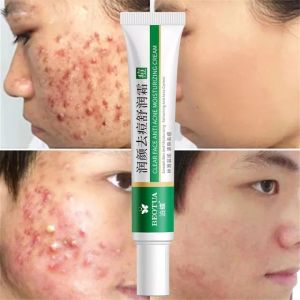 Effective Acne Removal Cream Acne Treatment Spots Oil Control Shrink Pores Whitening Moisturizing Anti-Acne Face Gel Care