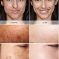 Dark Spot Correcting Brightening Serum Reduce Dark Spots Hyperpigmentation Lightening Acne Dark Patches Essence. 