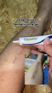 Gel Dermatix Ultra 15g - Dematix Gel Làm Mờ Sẹo Thâm làm phẳng sẹo Lồi Rỗ kem chấm mụn giảm sưng viêm phục