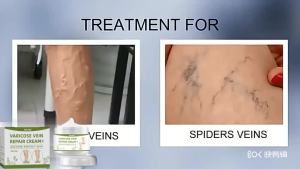 【Hot Sale】Eelhoe Varicose Vein Repair Cream Effective Convenient Plant Extracts Varicose Vein Repair Cream Relieve Pain Legs for Postpartum Obese People（50g）