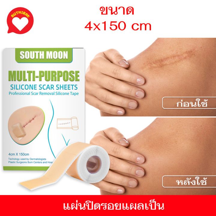 South Moon แผ่นปิดแผลซิลิโคน แผ่นแปะรอยแผลเป็น ซิลิโคนปิดแผล แผลผ่าตัด แผลหลังคลอด ซิลิโคนกำจัด