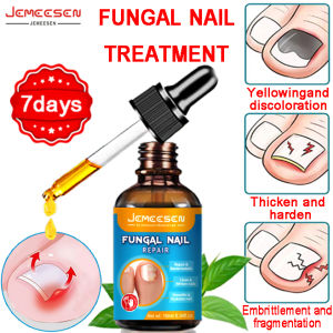 【Jemeesen】Nail polish Nail Fungus Treatment Nail Care ubat kuku kaki rosak nail fungus medicine fungal nail treatment Serum Repair Nail Fungus Removal Serum Gel Anti-Infection Paronychia Onychomycosis 灰指甲 真菌治疗 甲沟炎 Nail Repair Essence