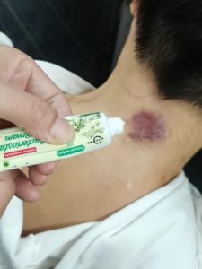 Buy 2 Take 3 ArnoOlea Dermatitis Cream Treatment Psoriasis Tinea cruris ItchingDermatitis