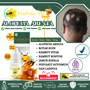 Obat Alopecia Areata Penumbuh Rambuh Botak Pria Dan Wanita Botak Koin Rambut Pitak Jamur Kulit Kepala Penghilang Botak Koin Dengan Propolis SM Asli 100% Original