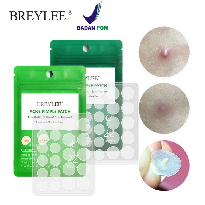 BPOM] BREYLEE Acne Pimple Patch/ Stiker Tempel Jerawat/ Acne Healing &  Blemish Spot Treatment - 01mm / 03mm | 22 patches/ Stiker Jerawat/ DAY AND  NIGHT/BISA COD Stiker Jerawat Bpom - Lazada | Lazada Indonesia