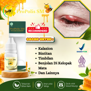 Propolis SM - Obat Kalazion Mata Bintitan Penghilang Benjolan Di Kelopak Mata Bengkak Nyeri Merah Pengempis Bengkak Kelopak Mata PALING AMPUH NAMUN SETIAP ORANG HASILNYA BERBEDA