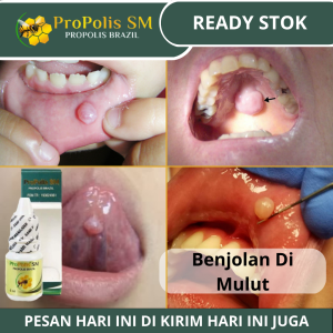 Obat Benjolan Di Mulut Obat Tetes Benjolan Di Bibir Obat Benjolan Di Lidah Kronis Obat Penghilang Bengkak Di Mulut Parah Obat Mucocele Obat Oles Pengempis Benjolan Lidah Sariawan Sakit Gusi Obat Menghilangkan Kista Lidah Dengan ProPolis SM