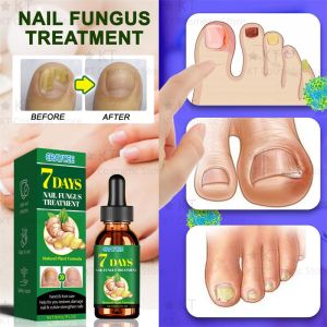 new 7 Days Fungal Nail Treatment Serum Foot Nail Fungus Removal Repair Gel Anti Infection Paronychia Onychomycosis Foot Nails Care hot
