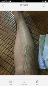 [FreeshipMAX] Tẩy lông chân tay nách ......vĩnh viễn sau 2 hủ