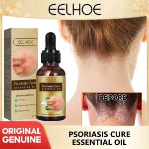 Eelhoe Psoriasis Antibacterial Serum Anti Itching Dermatitis Eczema Treatment Hydrating Eliminating Inflammatory Serum Skin Psoriasis Repair Essential Oil Anti Itch Swelling Hand Foot Dermatitis Antibacterial Relieve Itching Eczema Care
