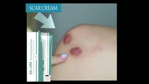 Fast Scar Remover Suitable For Old And New Scars On All Areas 100% Effectiv Peklat Remover Cream