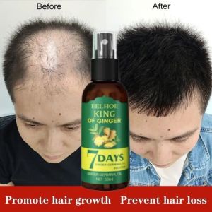 Eelhoe Serum Penumbuh Rambut  Of Ginger Clothes Of Skin 7 Days Ginger Germinal Oil Penumbuh Rambut Botak 30 Ml