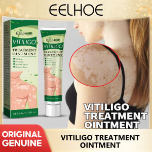 Eelhoe Whitespot Skin Repair Cream To Lighten Speckle Sweat Spot Hand And Foot Skin Moss Skin Repair Whitespot Cleansing Ointment  Vitiligo Remover Ointment White Spot Disease Treatment Cream Repair Melanin Pigment Antibacterial Leukoplakia Cream