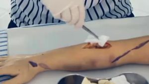 Kasa Lipat Steril Medis: Penggunaan & Manfaat