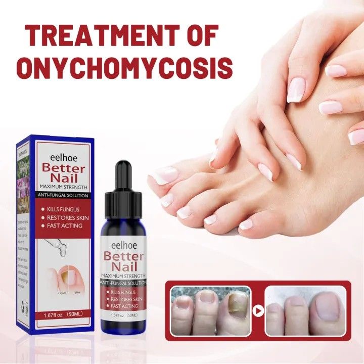 100 Effective Nail fungus repair treatment Footurel Gel Anti Fungal Ingrown Toenail Remover