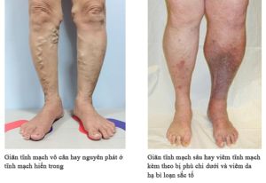 Kem Bôi Suy Giãn Tĩnh Mạch thành phần thảo dược thiên nhiên an toàn và hiệu nghiệm