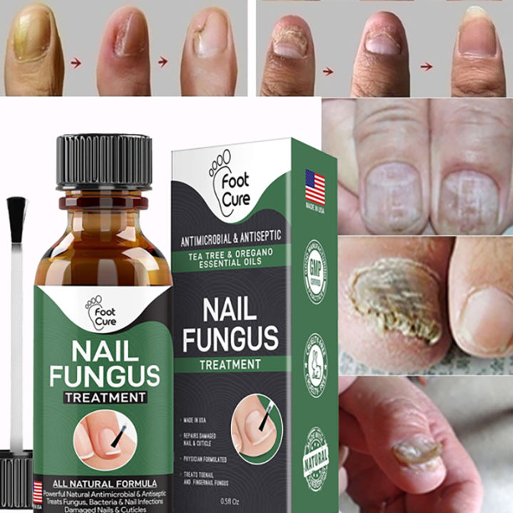 Bestope 30ml Nail Fungal Liquid Anti Fungal Nail Solution for Finger and  Toe Nails - Walmart.com