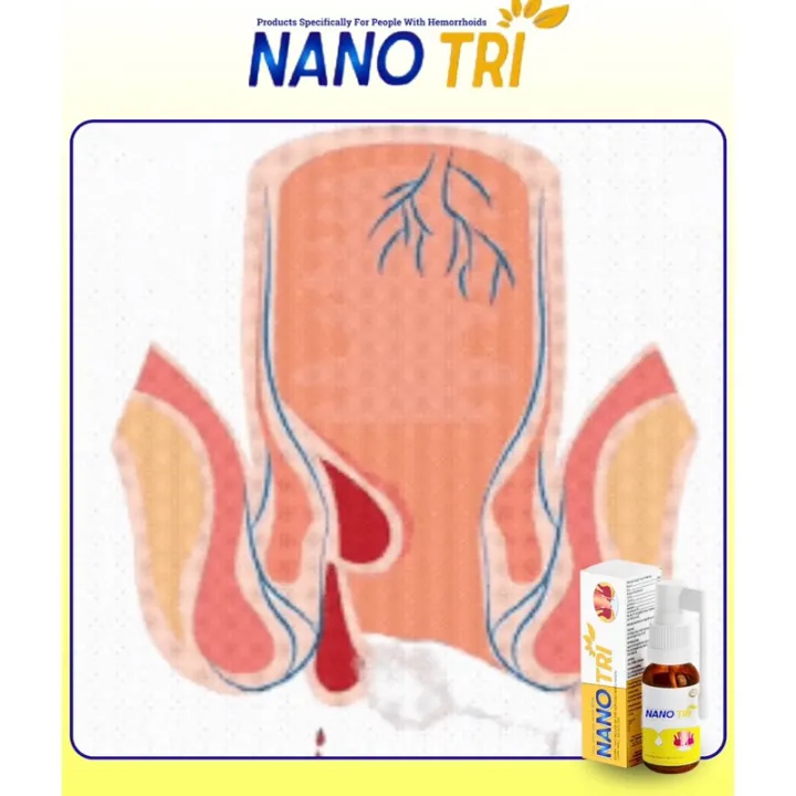 Nano%20Tri%20Hemorrhoid%20Relief%20-%20Sale%20Price%20-%20Buy%202%20Get%201%20Free%20-%20Instant%20Comfort%20and%20Healing%20-%20Image%207