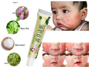 [BÉ MÁT – MẸ MÊ] Kem Bôi Dị Ứng Với Chiết Xuất Thảo Dược Cho Trẻ Em Dịu Da Hạ Nhiệt An Toàn Và Hiệu Quả