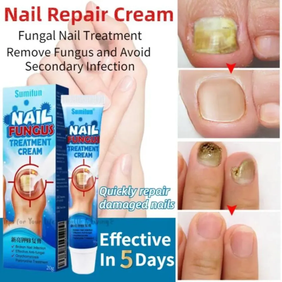 Fungal Infection Nail Treatment Essence Foot Toe Nail Fungus Onychomycosis  Removal Feet Care Cream at best price in Haridwar | ID: 25673575891