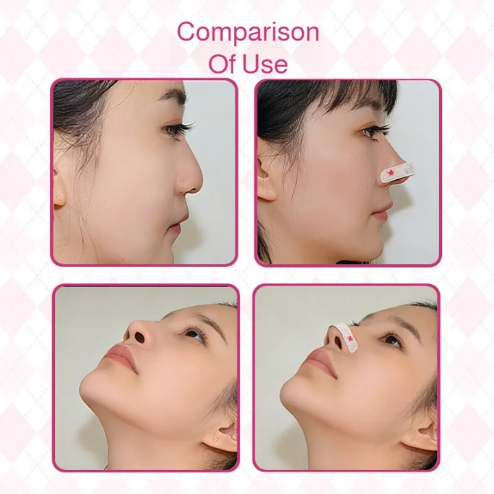 Professional%20Nose%20Shaper%20Adjustable%20Nose%20Wing%20Patch%20Memory%20Bridge%20Support%20Nose%20Lifting%20Wing%20Reduction%20Cosmetic%20Nose%20Enhancement%20Device%20-%20Image%203