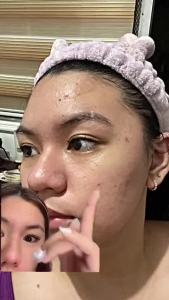 Salicylic Acid Acne Treatment Ice Sleep Masque Anti Acne Anti Pimple Remover Dark Spot Mark