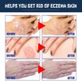 30ml Psoriasis Treatment Spray Hand Foot Scalp Eczema Tinea Anti-itch Rash Urticaria Desquamation Dermatitis Relief Spray. 