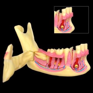 Teeth Model Dental Implant Model Dental Teaching Model Removable Tooth Model