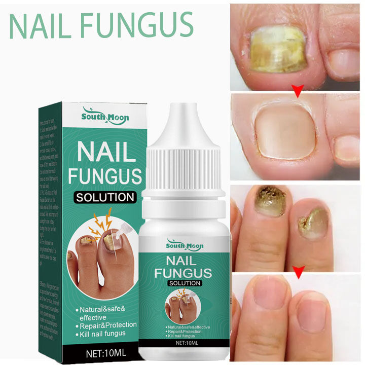 Nail treatment fungal anti fungal for nails repair treatment cream gel ...