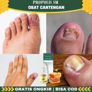 Obat Cantengan Obat Cantengan Jempol Kaki Obat Kuku Cantengan Obat Kuku Rusak Bernanah Bengkak Berdarah Propolis SM 100% ASLI
