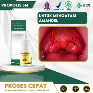 Obat Untuk Mengatasi Amandel Amandel Kronis Radang Tenggorokan Infeksi Tenggorokan Dengan Propolis SM