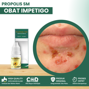 Obat Impetigo Kulit Gatal Obat Infeksi Gatal Kulit Obat Impetigo Anak Impetigo Krustosa Obat Gatal Ruam Pada Wajah Obat Gatal Ruam Merah Obat Infeksi Jamur Kulit Dengan Propolis SM
