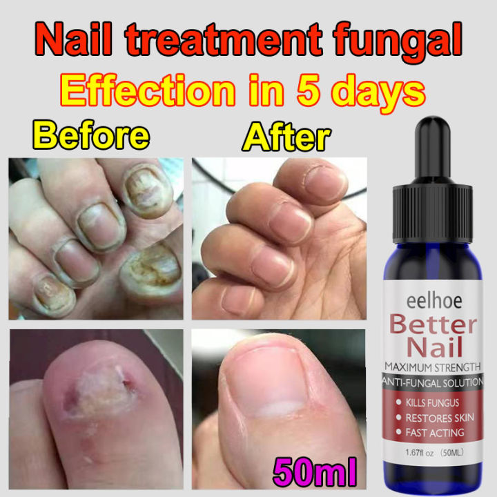 🔥Effection in 5 days🔥Nail Repair Essence 50ml Inhibit Fungal Nail ...