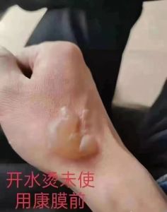 💗🙋♀️💗疤痕膏修护疤痕剖腹产平衡疤疤手术疤痕痘印痘坑美容院零原料供应