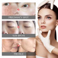 EELHOE Pigment Correcting Cream Freckles Removal Cream Pigment Correcting Serum Remove Melasma Age Spots Sunspots Whitening Freckle Removing Cream Effective Brightening Essence Remove Pigment Melanin Correct Beauty Facial Skin Care. 