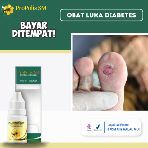 Obat Luka Diabetes Di Kaki Obat Diabetes Basah Obat Pengering Luka Diabetes Obat Untuk Diabetes Obat Diabetes Agar Cepat Kering Obat Luka Bernanah Obat Luka Gangren Obat Luka Diabetes Melitus Dengan Propolis SM