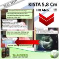 Obat Miom Paling Ampuh Tanpa Operasi, Miom Ukuran 12cm, Miom Uteri, Miom Di Rahim, Miom Dan Kista, Herbal Miom - Mbiopro Asli Original. 