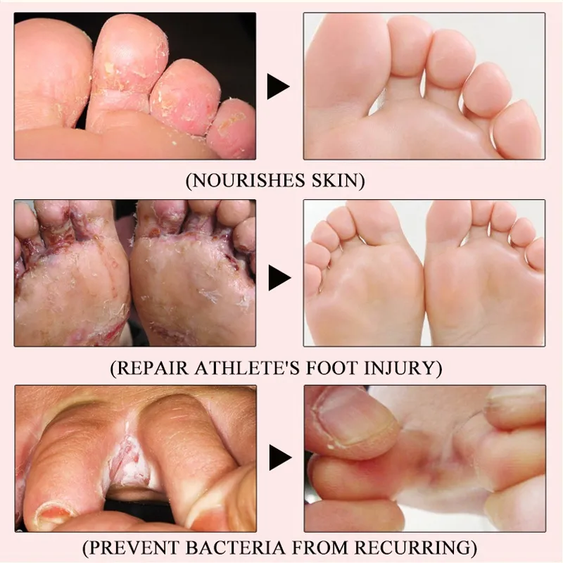 Athlete's Foot My Heels Are Always Cracked Cracked Heels And