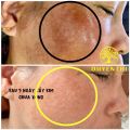Cấy Kim Nanotech Bạch Linh 1 2 Duyên Thị Bách Y Sâm. 