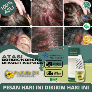 Obat Tetes Borok Di Kulit Kepala Obat Korengan Di Kepala Obat Jamur di Kulit Kepala Obat Gatal Gatel Kulit Kepala Koreng Berjamur Psoriasis Kepala Obat Kulit Kepala Berkerak Bersisik Mengelupas Ketombe Parah Eksim Kering Dengan Propolis SM