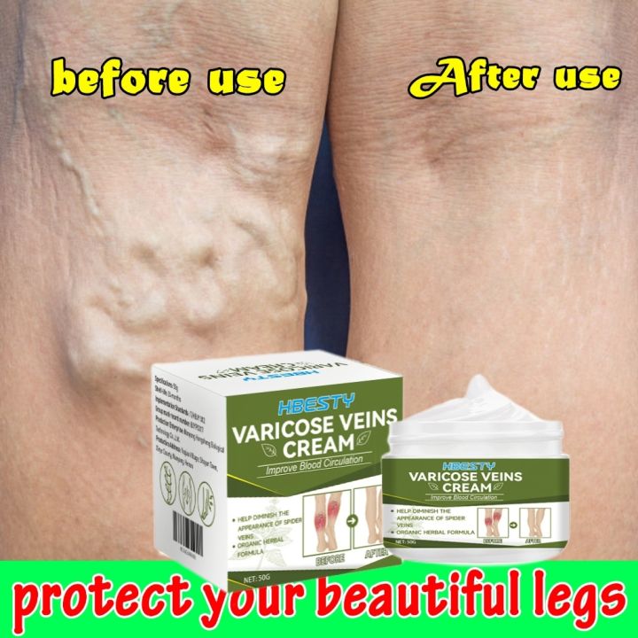 Varicose Vein Remover Varicose Cream Varicosity Angiitis Remedy 